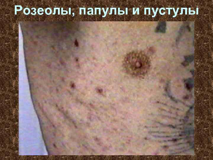 Розеолы, папулы и пустулы 
