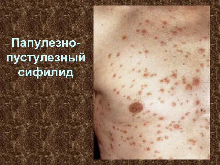 Папулезнопустулезный сифилид 