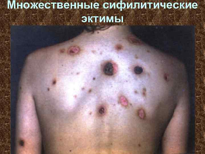 Множественные сифилитические эктимы 