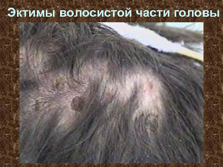 Эктимы волосистой части головы 