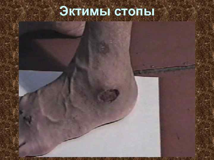 Эктимы стопы 