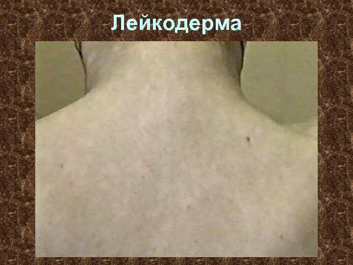 Лейкодерма 