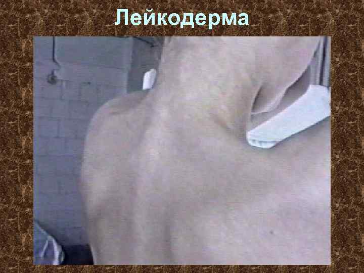 Лейкодерма 