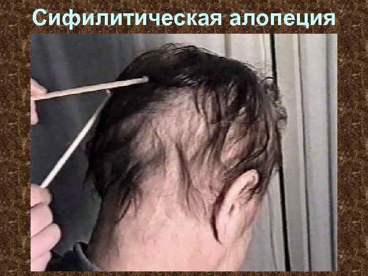 Сифилитическая алопеция 