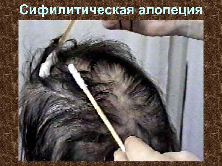 Сифилитическая алопеция 