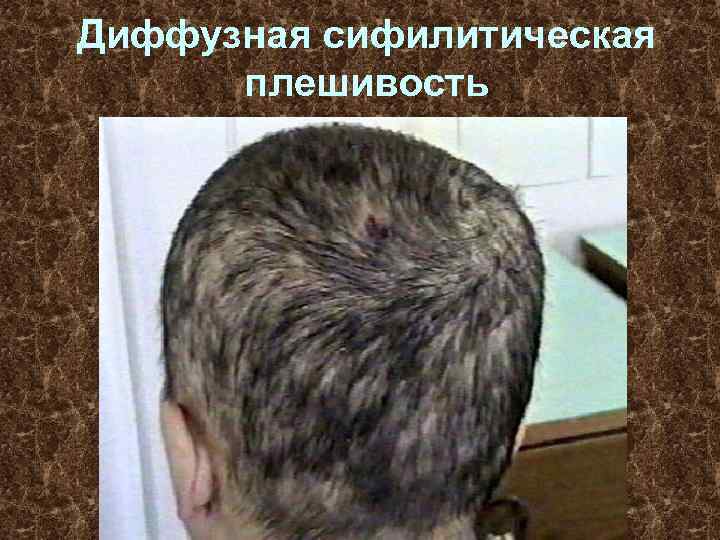 Диффузная сифилитическая плешивость 