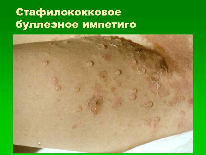 Стафилококковое буллезное импетиго 