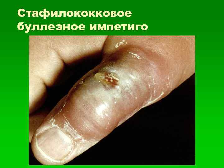 Стафилококковое буллезное импетиго 