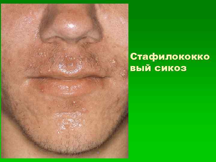 Стафилококко вый сикоз 