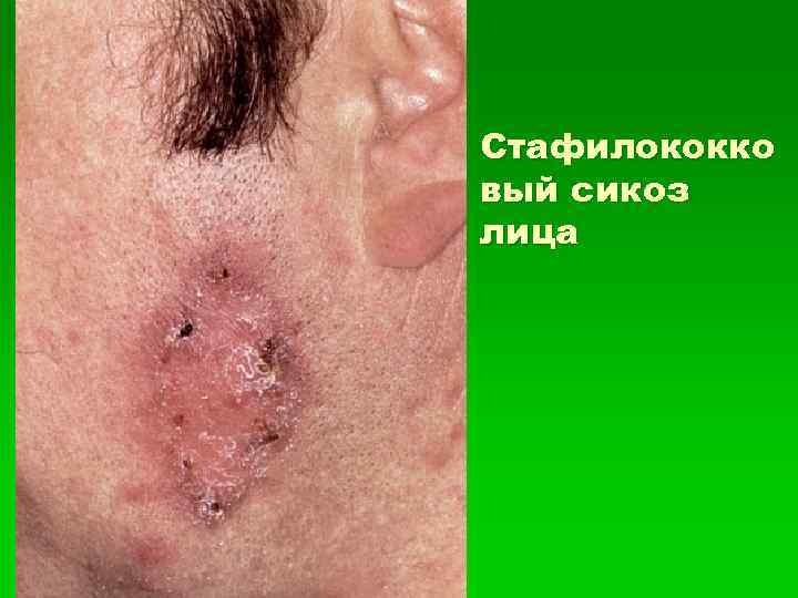 Стафилококко вый сикоз лица 