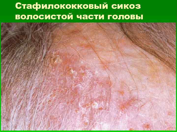 Стафилококковый сикоз волосистой части головы 
