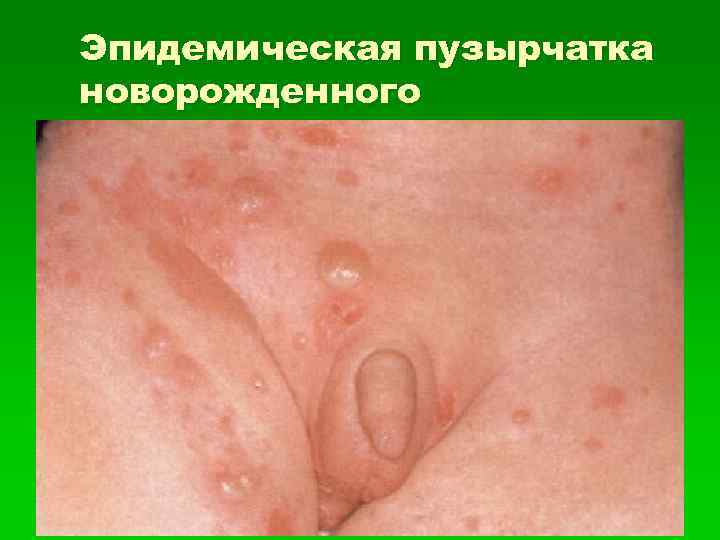 Эпидемическая пузырчатка новорожденного 
