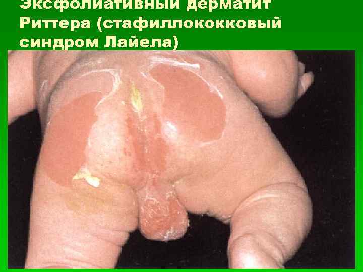Эксфолиативный дерматит Риттера (стафиллококковый синдром Лайела) 