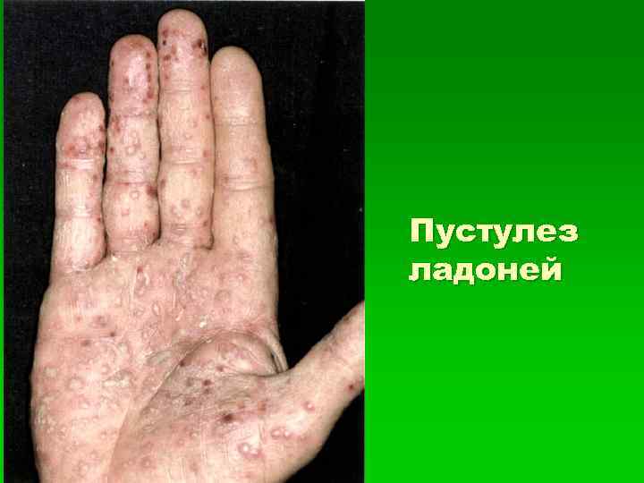 Пустулез ладоней 