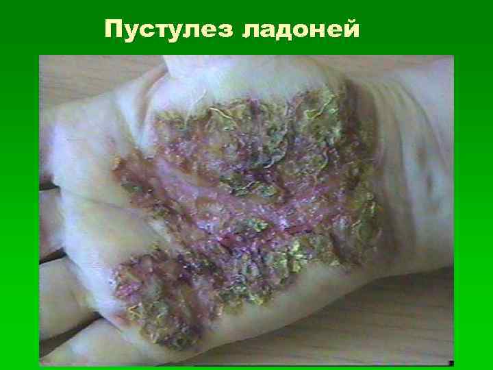 Пустулез ладоней 