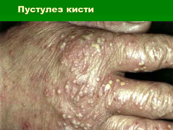 Пустулез кисти 