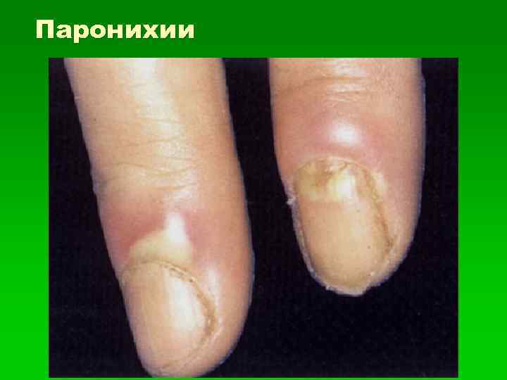 Паронихии 