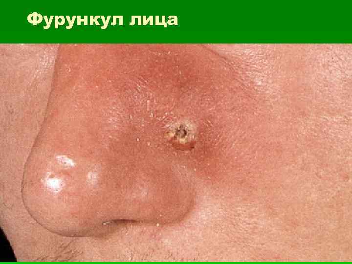 Фурункул лица 