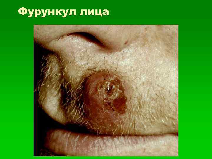 Фурункул лица 