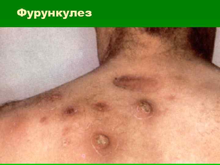 Фурункулез 