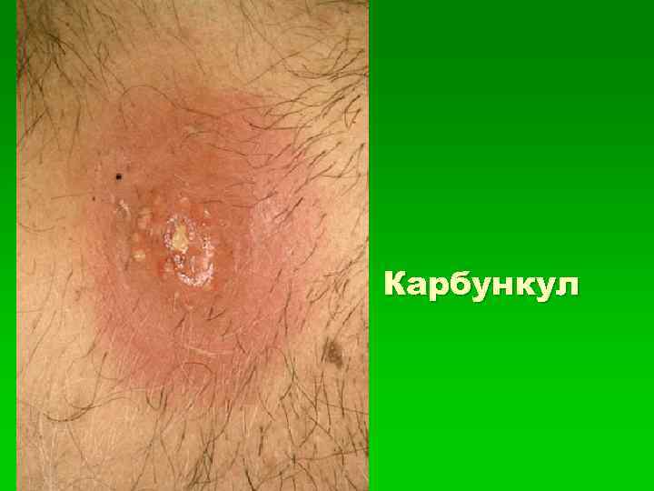 Карбункул 