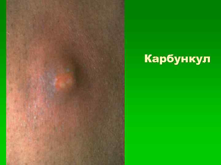 Карбункул 