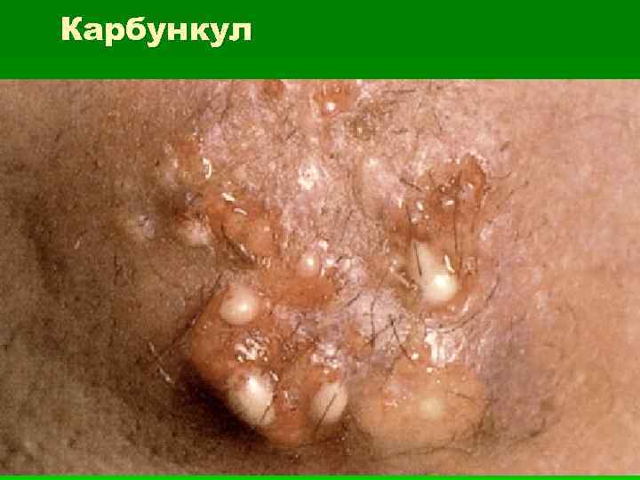 Карбункул 