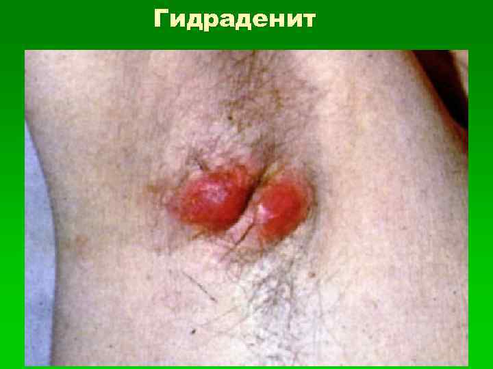 Гидраденит 