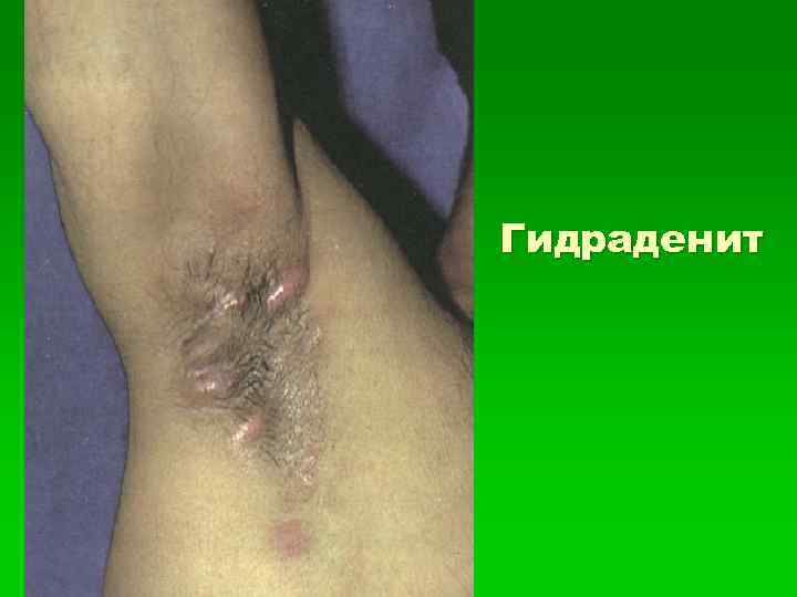 Гидраденит 