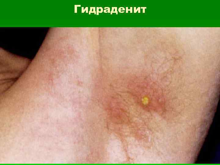 Гидраденит 