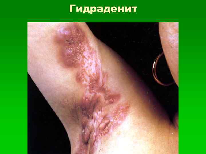 Гидраденит 