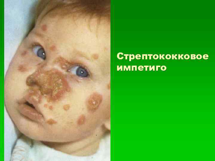 Стрептококковое импетиго 