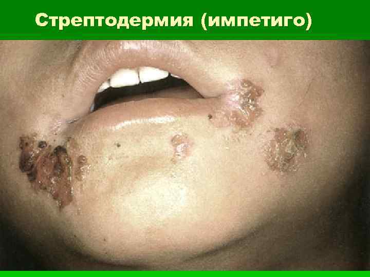 Стрептодермия (импетиго) 