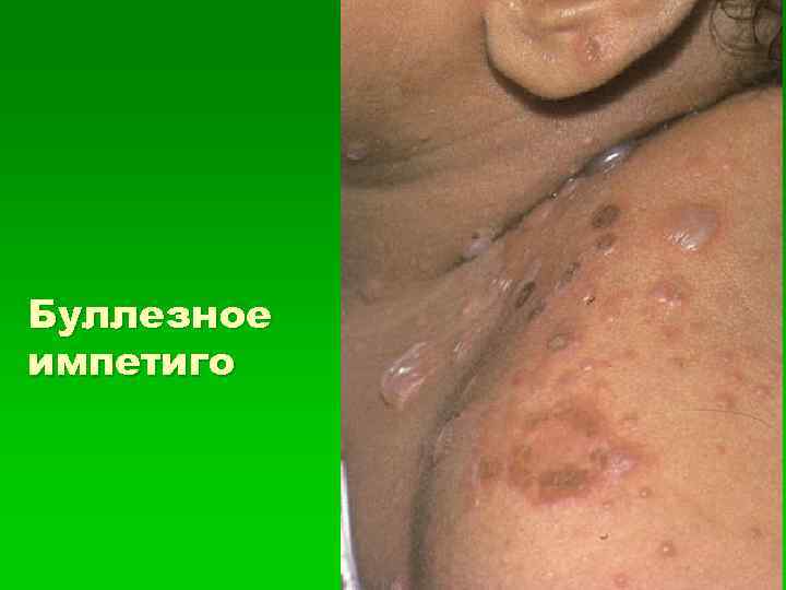 Буллезное импетиго 