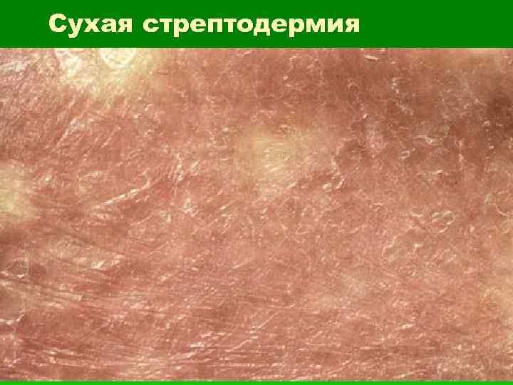 Сухая стрептодермия 