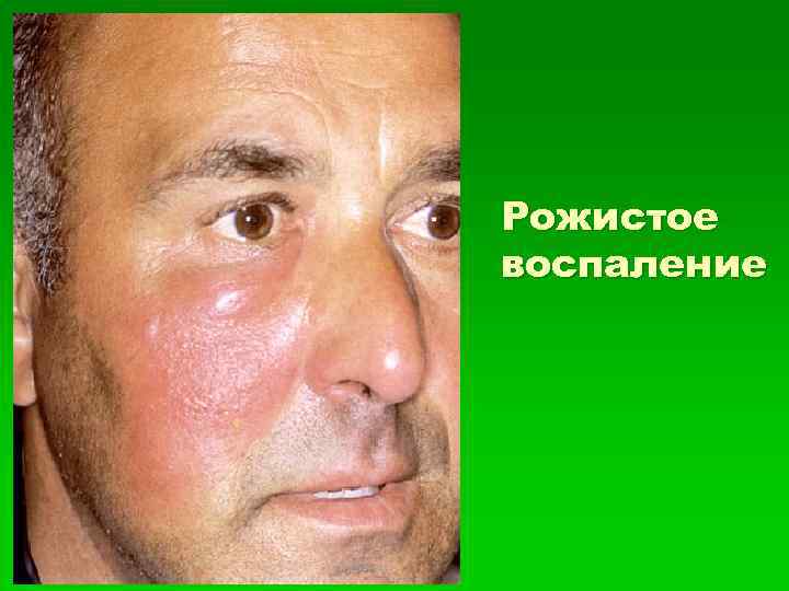 Рожистое воспаление 