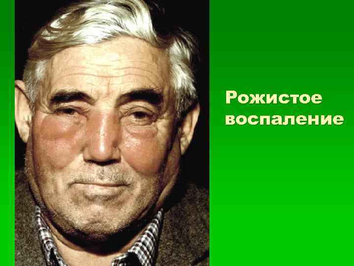 Рожистое воспаление 
