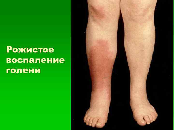 Рожистое воспаление голени 