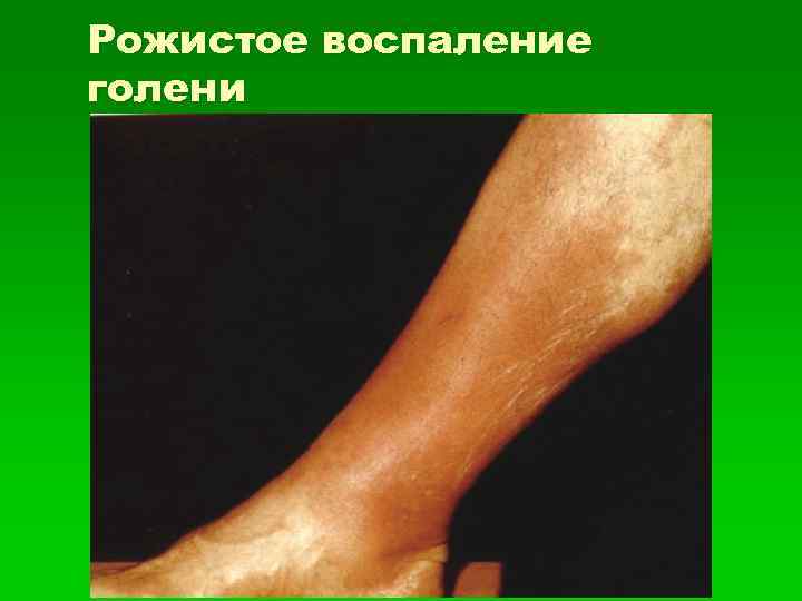 Рожистое воспаление голени 
