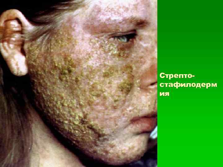 Стрептостафилодерм ия 