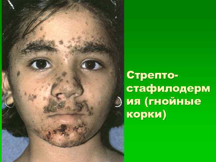 Стрептостафилодерм ия (гнойные корки) 