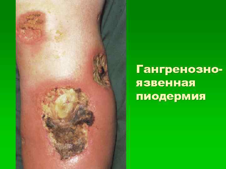 Гангренозноязвенная пиодермия 