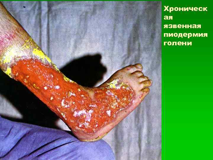 Хроническ ая язвенная пиодермия голени 