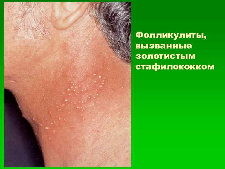 Фолликулиты, вызванные золотистым стафилококком 