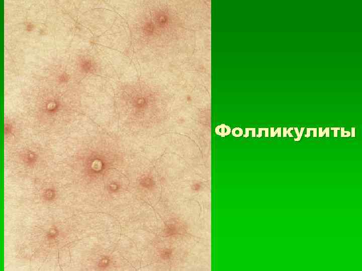Фолликулиты 