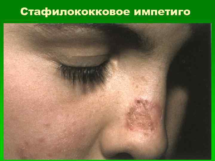 Стафилококковое импетиго 
