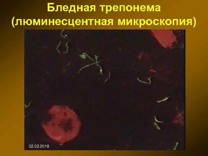 Бледная трепонема (люминесцентная микроскопия) 02. 2018 