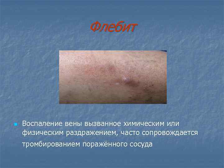 Флебит n Воспаление вены вызванное химическим или физическим раздражением, часто сопровождается тромбированием поражённого сосуда
