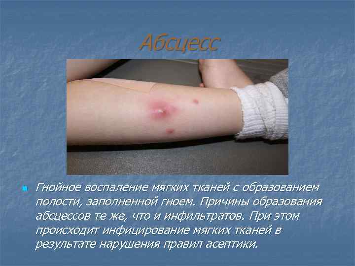 Абсцесс n Гнойное воспаление мягких тканей с образованием полости, заполненной гноем. Причины образования абсцессов