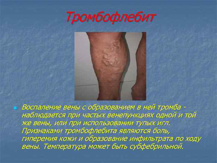 Тромбофлебит n Воспаление вены с образованием в ней тромба наблюдается при частых венепункциях одной